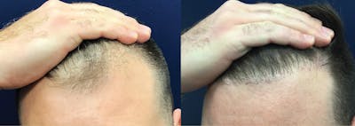 Hair Restoration Before & After Gallery - Patient 144174638 - Image 1
