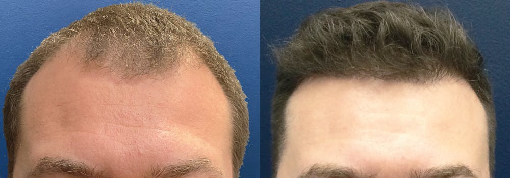 Hair Restoration Before & After Gallery - Patient 144174637 - Image 1