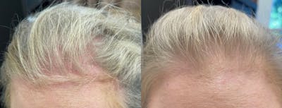 TED Hair Restoration Before & After Gallery - Patient 144174675 - Image 1