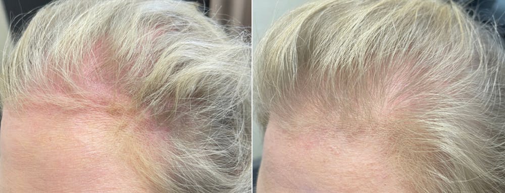 TED Hair Restoration Before & After Gallery - Patient 144174675 - Image 2