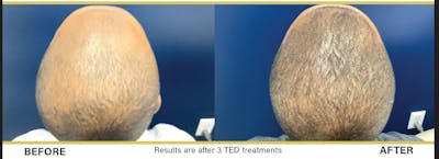 TED Hair Restoration Before & After Gallery - Patient 145033213 - Image 1