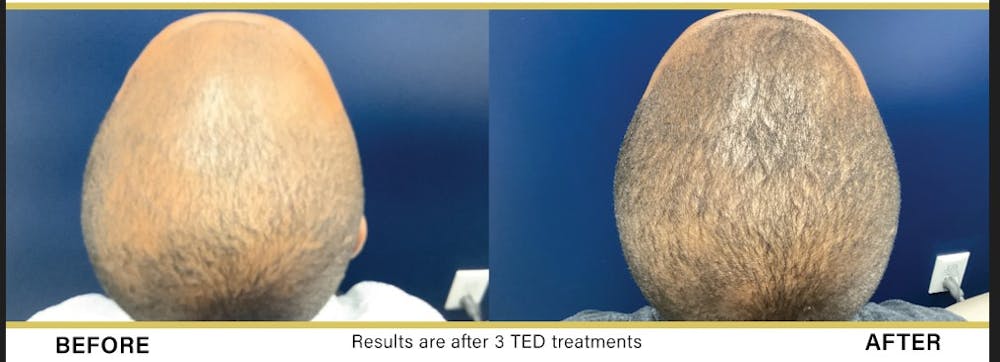TED Hair Restoration Before & After Gallery - Patient 145033213 - Image 1