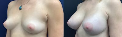 Breast Augmentation Before & After Gallery - Patient 146376498 - Image 2