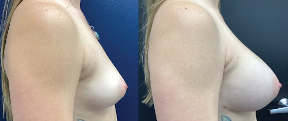 Breast Augmentation Before & After Gallery - Patient 146376498 - Image 3