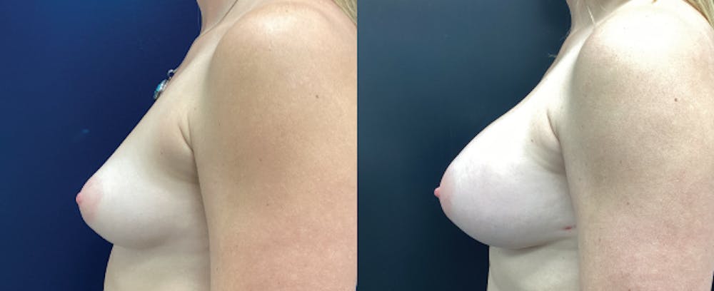 Breast Augmentation Before & After Gallery - Patient 146376498 - Image 4