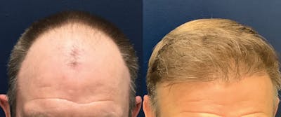 Hair Restoration Before & After Gallery - Patient 147494033 - Image 1