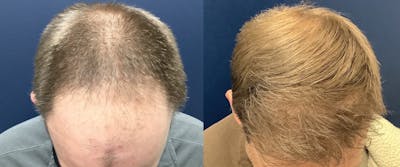 Hair Restoration Before & After Gallery - Patient 147494033 - Image 2