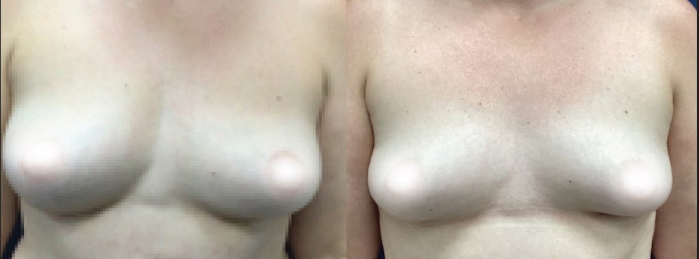 Breast Augmentation Before & After Gallery - Patient 161640 - Image 1