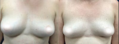 Breast Augmentation Before & After Gallery - Patient 161640 - Image 1