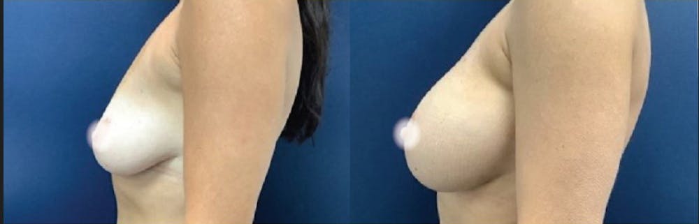 Breast Augmentation Before & After Gallery - Patient 233612 - Image 1