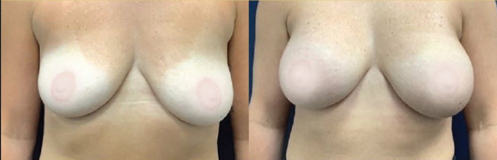 Breast Augmentation Before & After Gallery - Patient 256440 - Image 1