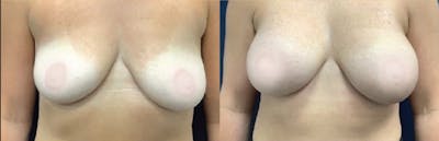 Breast Augmentation Before & After Gallery - Patient 256440 - Image 1