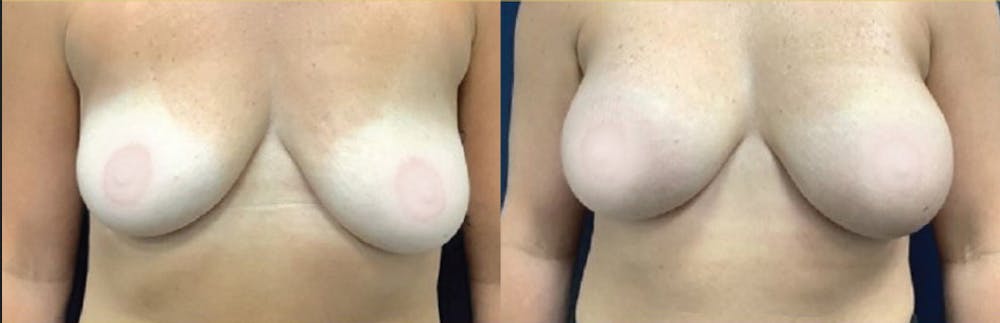 Breast Augmentation Before & After Gallery - Patient 256440 - Image 1
