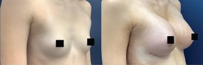 Breast Augmentation Before & After Gallery - Patient 218516 - Image 2