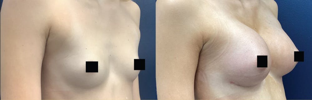 Breast Augmentation Before & After Gallery - Patient 218516 - Image 2