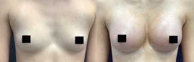 Breast Augmentation Before & After Gallery - Patient 218516 - Image 1