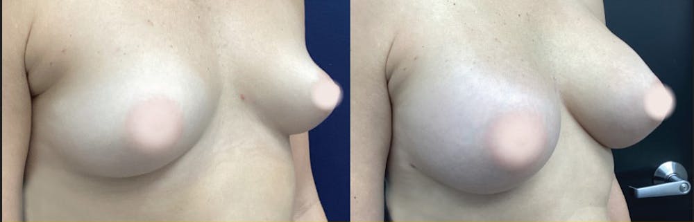 Breast Augmentation Before & After Gallery - Patient 920915 - Image 2