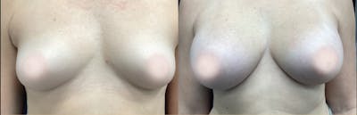 Breast Augmentation Before & After Gallery - Patient 920915 - Image 1