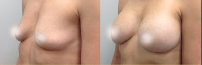 Breast Augmentation Before & After Gallery - Patient 135656 - Image 2