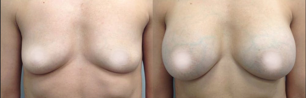 Breast Augmentation Before & After Gallery - Patient 135656 - Image 1