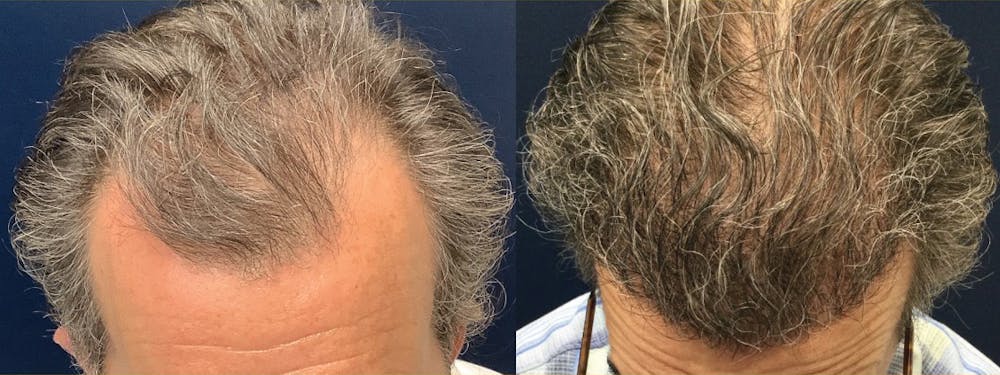 Hair Restoration Before & After Gallery - Patient 235559 - Image 1