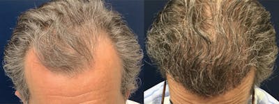 Hair Restoration Before & After Gallery - Patient 235559 - Image 1