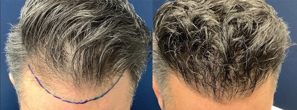 Hair Restoration Before & After Gallery - Patient 131023 - Image 1