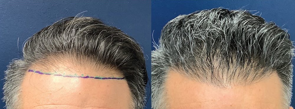 Hair Restoration Before & After Gallery - Patient 131023 - Image 2