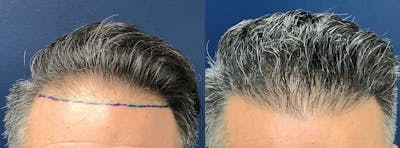 Hair Restoration Before & After Gallery - Patient 131023 - Image 2