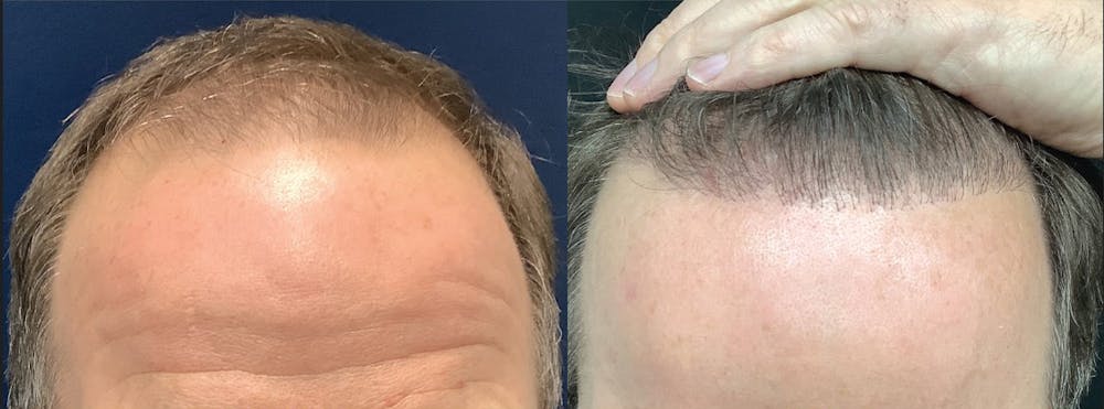 Hair Restoration Before & After Gallery - Patient 905529 - Image 1