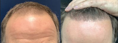 Hair Restoration Before & After Gallery - Patient 905529 - Image 1