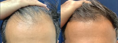 Hair Restoration Before & After Gallery - Patient 173881 - Image 1