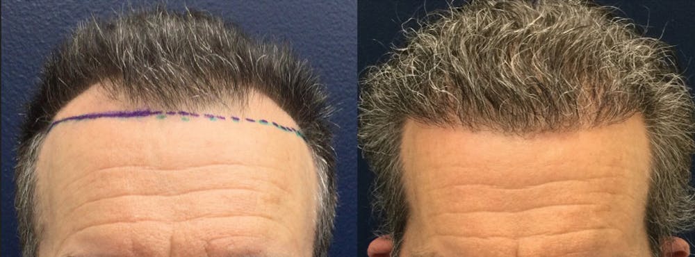 Hair Restoration Before & After Gallery - Patient 104639 - Image 1