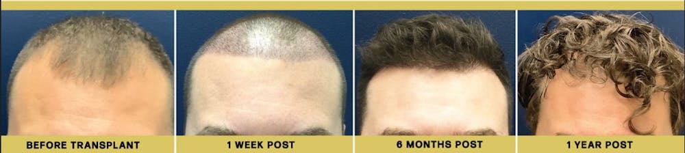 Hair Restoration Before & After Gallery - Patient 315298 - Image 1