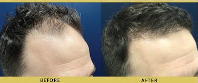 Hair Restoration Before & After Gallery - Patient 395818 - Image 1