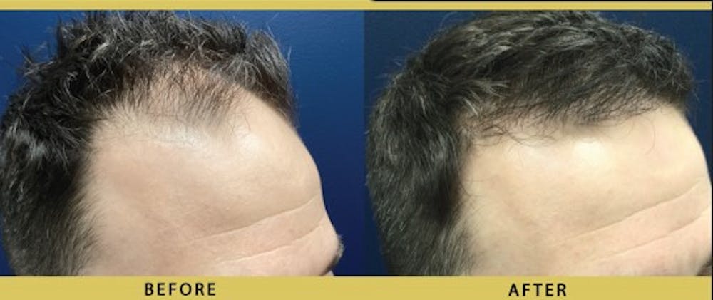 Hair Restoration Before & After Gallery - Patient 395818 - Image 1