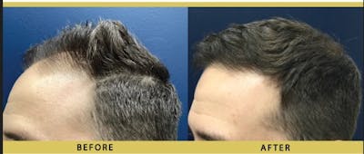 Hair Restoration Before & After Gallery - Patient 395818 - Image 2