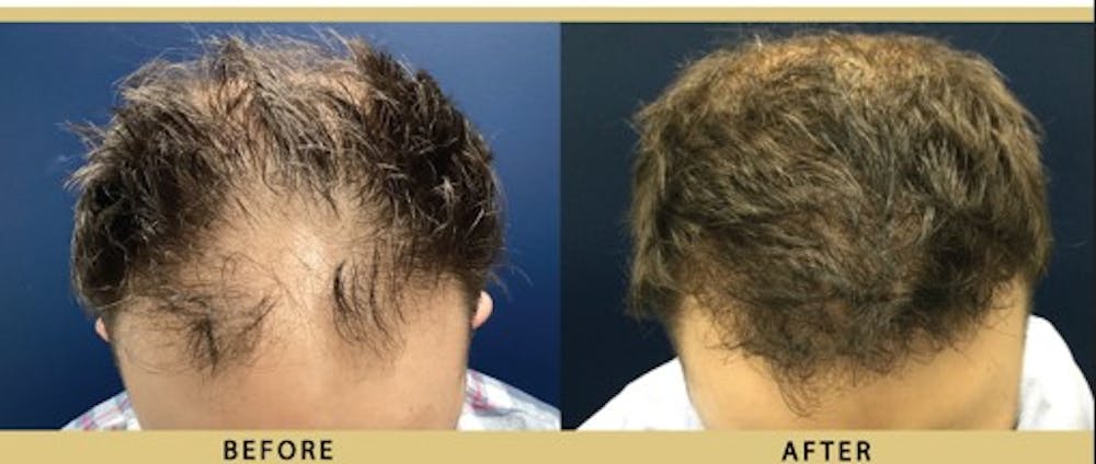 Hair Restoration Before & After Gallery - Patient 340581 - Image 1