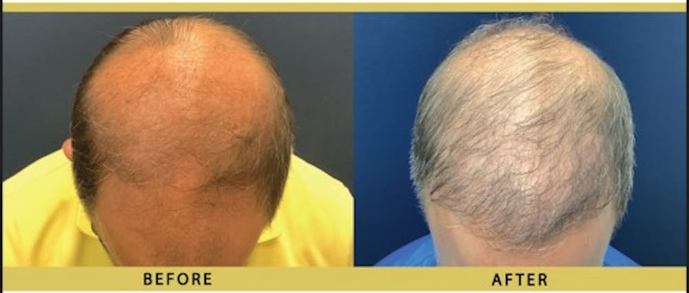 Hair Restoration Before & After Gallery - Patient 164494 - Image 1