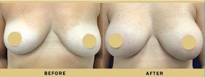 Breast Augmentation Before & After Gallery - Patient 205595 - Image 1