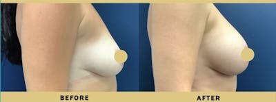Breast Augmentation Before & After Gallery - Patient 205595 - Image 2