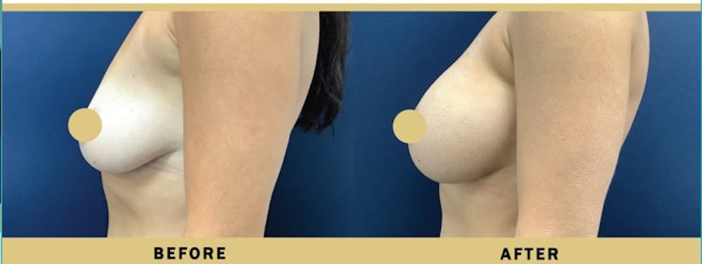 Breast Augmentation Before & After Gallery - Patient 205595 - Image 3