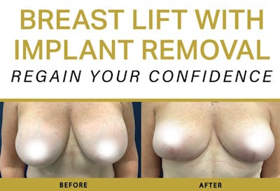 Breast Augmentation Before & After Gallery - Patient 203927 - Image 1