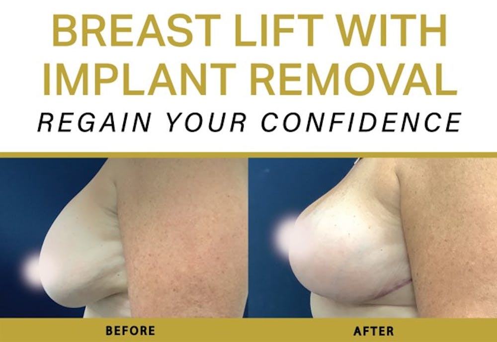 Breast Augmentation Before & After Gallery - Patient 203927 - Image 3