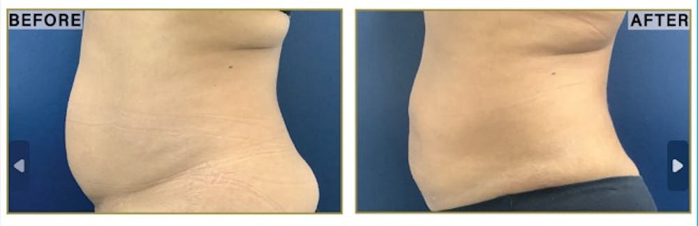 Liposuction Before & After Gallery - Patient 183476 - Image 5
