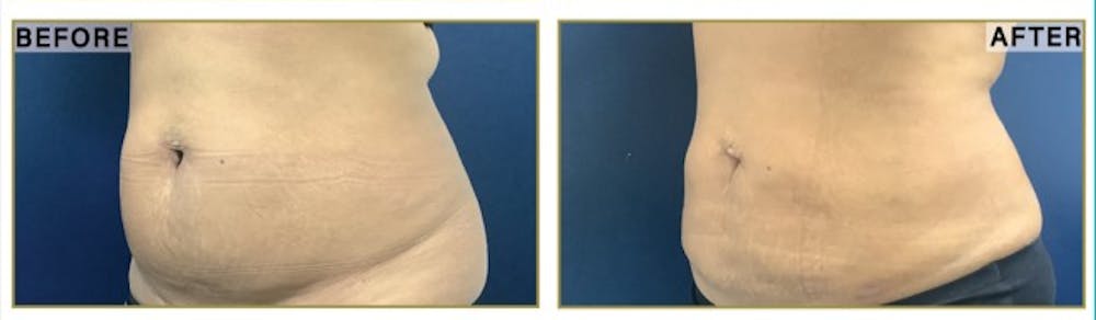 Liposuction Before & After Gallery - Patient 183476 - Image 4