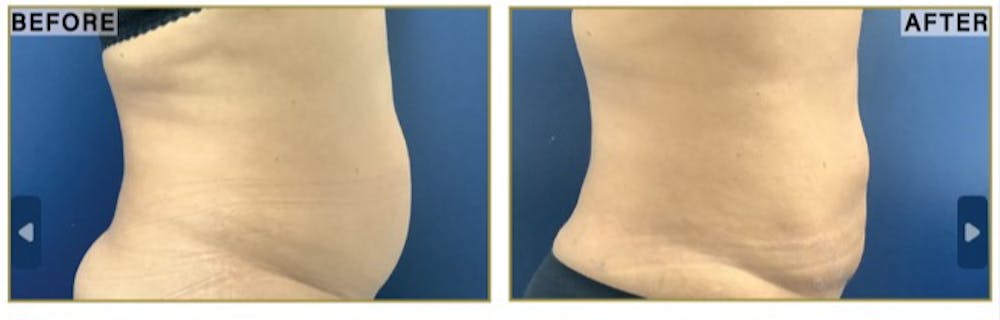 Liposuction Before & After Gallery - Patient 183476 - Image 3