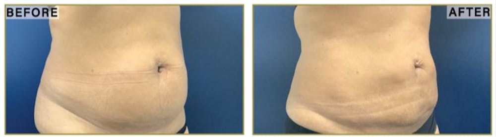 Liposuction Before & After Gallery - Patient 183476 - Image 2
