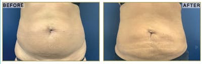 Liposuction Before & After Gallery - Patient 183476 - Image 1