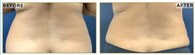 Liposuction Before & After Gallery - Patient 183476 - Image 6